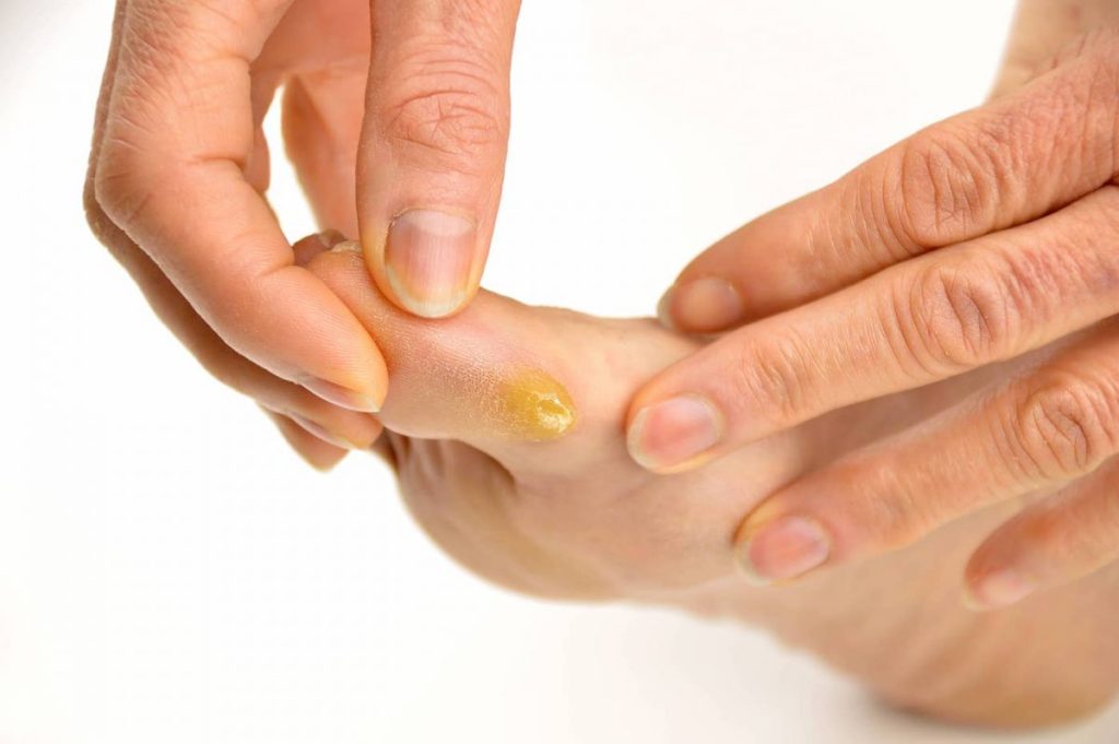 Understanding and Managing Foot Calluses: A Simple Guide